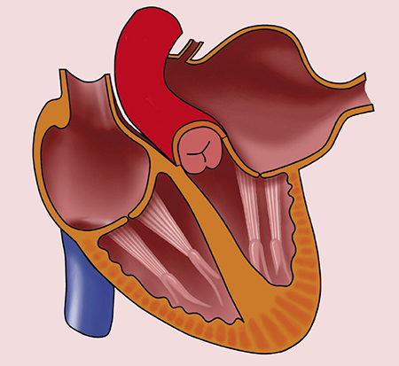 بزرگ شدن دهلیز چپ اغلب با نارسایی میترال همراه است بزرگ شدن دهلیز چپ, علت بزرگ شدن دهلیز چپ