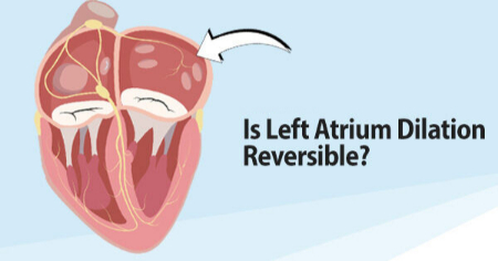 بزرگ شدن دهلیز چپ هشدار بیماری قلبی است بزرگ شدن دهلیز چپ, علت بزرگ شدن دهلیز چپ