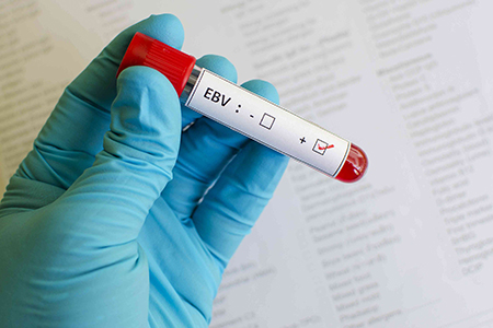 آزمایش ویروس اپشتین بار, علائم ویروس اپشتین بار, پیشگیری و درمان ویروس اپشتین بار