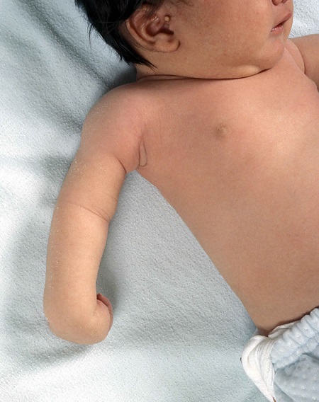 نوزاد مبتلا به فلج ارب دوشن, تمرین درمانی در فلج ارب, فلج ارب چیست
