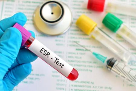 شرایط انجام آزمایش ESR شرایط انجام آزمایش ESR