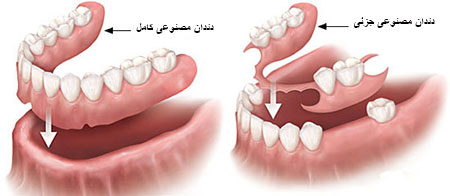  انواع دندان مصنوعی ثابت, ویزگی دندان مصنوعی خوب