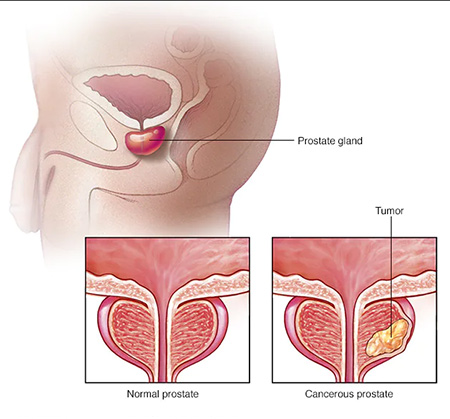 روش های درمان سرطان پروستات بدخیم,هورمون درمانی برای درمان سرطان پروستات,فریز کردن بافت پروستات (کرایوتراپی)