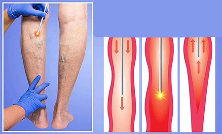 لیزر درون وریدی, درمان واريس, درمان رگهای واریسی