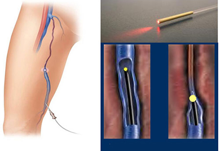 لیزر درون وریدی, درمان واريس, EVLA درمان موثری برای واریس است