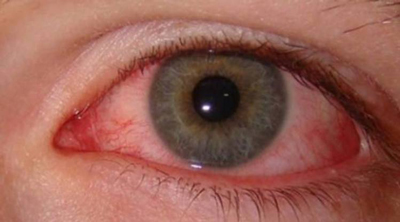 عارضه چشم صورتی، نشانه ویروس کرونا یا COVID-19 است