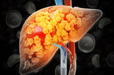 قند زیاد اولین دلیل کبد چرب و تاری دید است علائم کبد چرب در چشم, درمان کبد چرب با طب سنتی