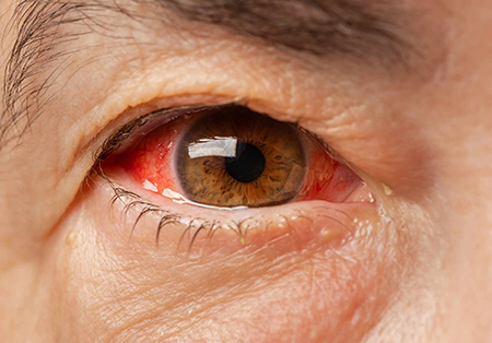 کوچک شدن ناگهانی چشم, کوچک شدن چشم در اثر بوتاکس, کوچک شدن چشم ها با افزایش سن