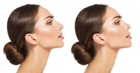 مدل جراحی بینی زنانه, جراحی بینی گوشتی