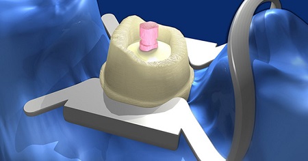 فایبر پست ها در بازسازی دندان , مراحل فایبر پست , ترمیم دندان با فایبر پست 