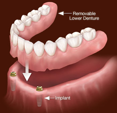 پروتز کامل دندان,دوام پروتز دندان,پروتز دندان
