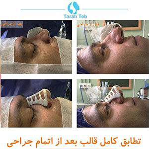 عمل بینی گوشتی عمل بینی گوشتی,جراحی بینی گوشتی,عوارض عمل بینی گوشتی