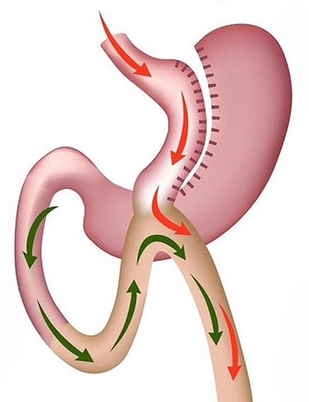 روش مینی بای پس معده, مراحل مینی بای پس معده, کاهش وزن با مینی بای پس
