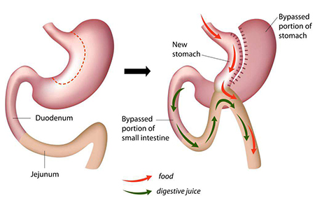  عمل مینی بای پس معده, مینی بای پس معده چیست, تغذیه پس از مینی بای پس معده 