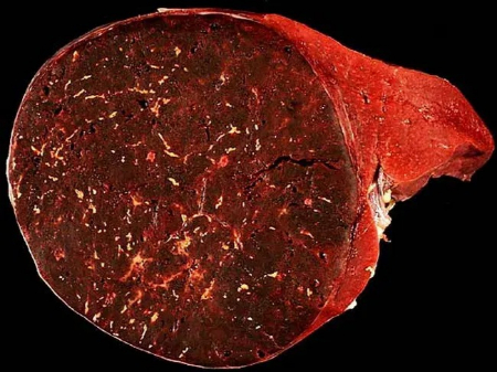 هامارتوما از همان بافتهای طبیعی بدن ساخته شده است هامارتوما, تومور خوش خیم ریه