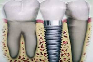 دندانپزشک, دندان درد, ایمپلنت