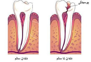 دندان, پرکردن دندان, پوسیدگی دندان