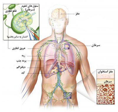 سرطان لنفوم هوچکین, علائم لنفوم هوچكين