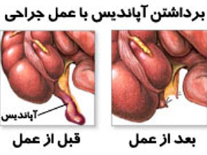 علائم آپاندیس, پارگی آپاندیس, درمان آپاندیس