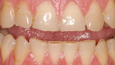 حساسیت دندان‌ها, مینای دندان, درمان دندان‌قروچه