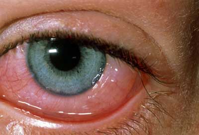 حساسیت‌های چشمی, آلرژی چشم, قرمزی چشم