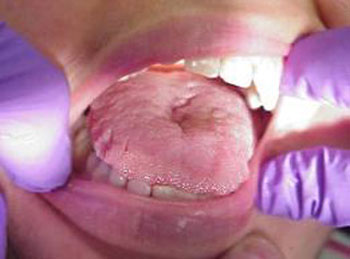 التهاب‌ حاد زبان, كم‌خوني‌, آلرژيهاي غذايي