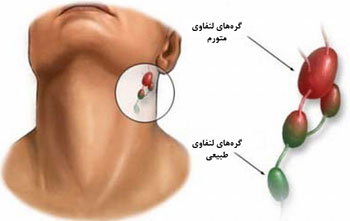 درمان  بیماری دیفتری, علائم دیفتری