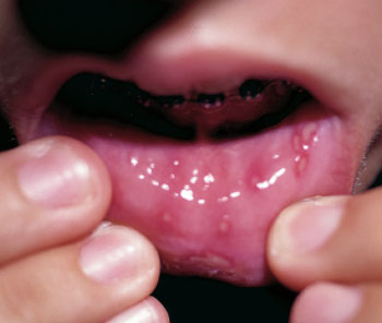  بيماري‌های عفوني, التهاب ويروسي دهان