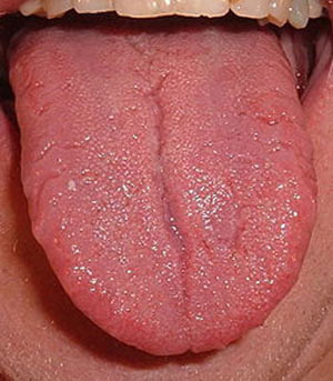 بیماریهای زبان, سندرم داون