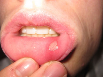 علائم آفت دهان, سیستم ایمنی بدن