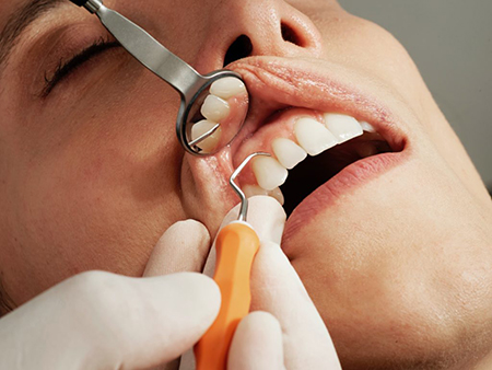 درمان دندان های فاصله دار,ترمیم دندان‌های جلویی