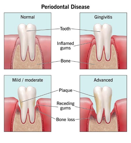 نشانه‌های بیماری لثه, بهداشت دهان و دندان