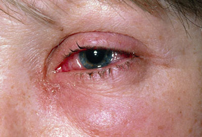 بیماری‌های چشمی, آب سياه چشم