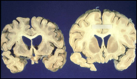  تحلیل مغز, بیماری کروتزفلد جاکوب