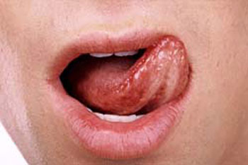 عوامل ایجاد سرطان زبان, مصرف دخانیات