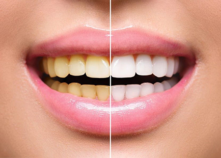 راه حل فوری برای سفید کردن دندان‌ها,بهترین روش سفید کردن دندان ها