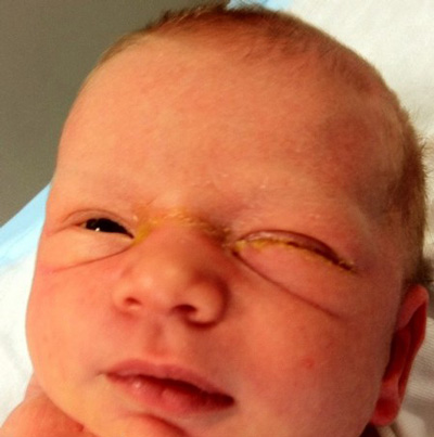 بهترین راه درمان قی چشم, درمان قی چشم نوزاد