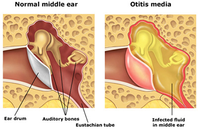 عوارض عفونت گوش, نشانه های عفونت گوش