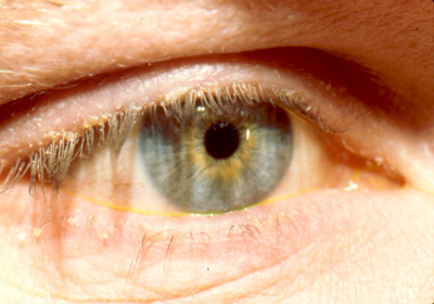 عفونت و قی چشم نوزاد, بیماری های چشمی