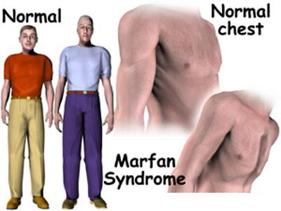 بیماری سندرم مارفان, پیشگیری از سندرم مارفان
