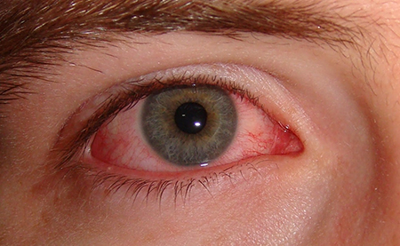 قرمزی چشم نشانه چیست, درمان قرمزی چشم