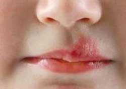 چه موقع تبخال می زنید و راه های سرایت آن