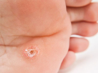 درمان میخچه انگشت پا با طب گیاهی