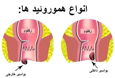 انواع بواسیر بواسیر,هموروئید,شقاق