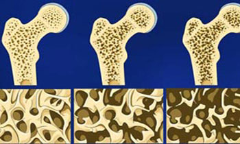 تقویت استخوا‌ن‌ها,گیاهان موثر برای تقویت استخوان ها,پیشگیری از پوکی استخوان