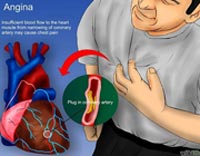 سکته قلبی,علائم سکته قلبی, رایج ترین علامت حمله قلبی