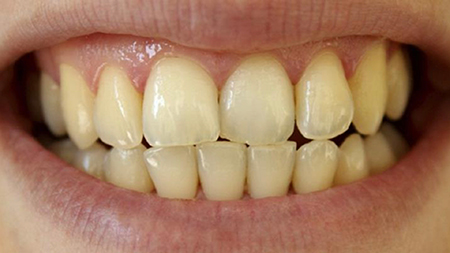 بدرنگی دندانها, علت  بدرنگ شدن دندان ها