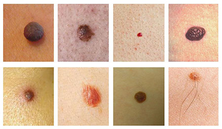 انواع سرطان پوست با عکس, علائم سرطان پوست چیست