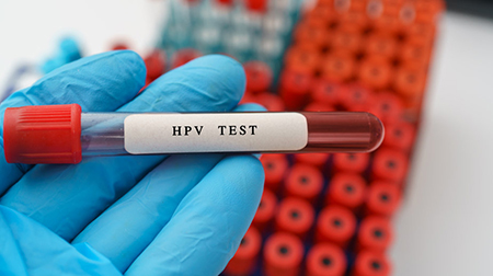 آزمایش HPV یا زگیل تناسلی, آزمایش hpv خون, آزمایش hpv زنان