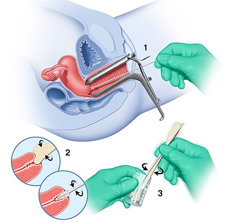 آزمایش HPV یا زگیل تناسلی, آزمایش hpv خون, آزمایش hpv زنان